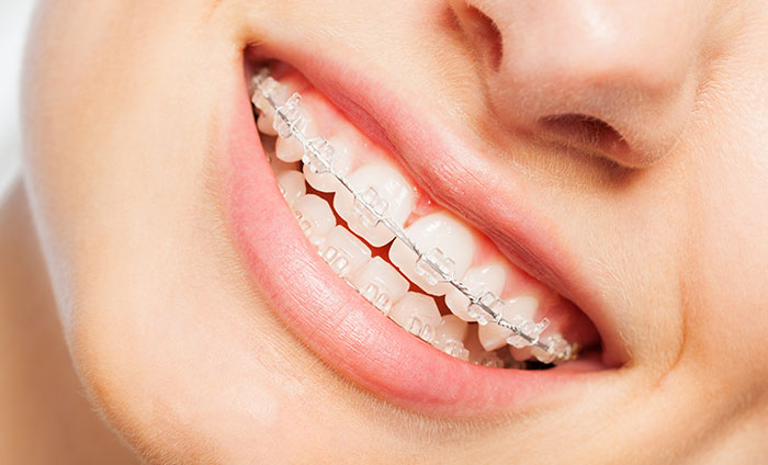 ORTODONCIA ESTETICA EN CUENCA