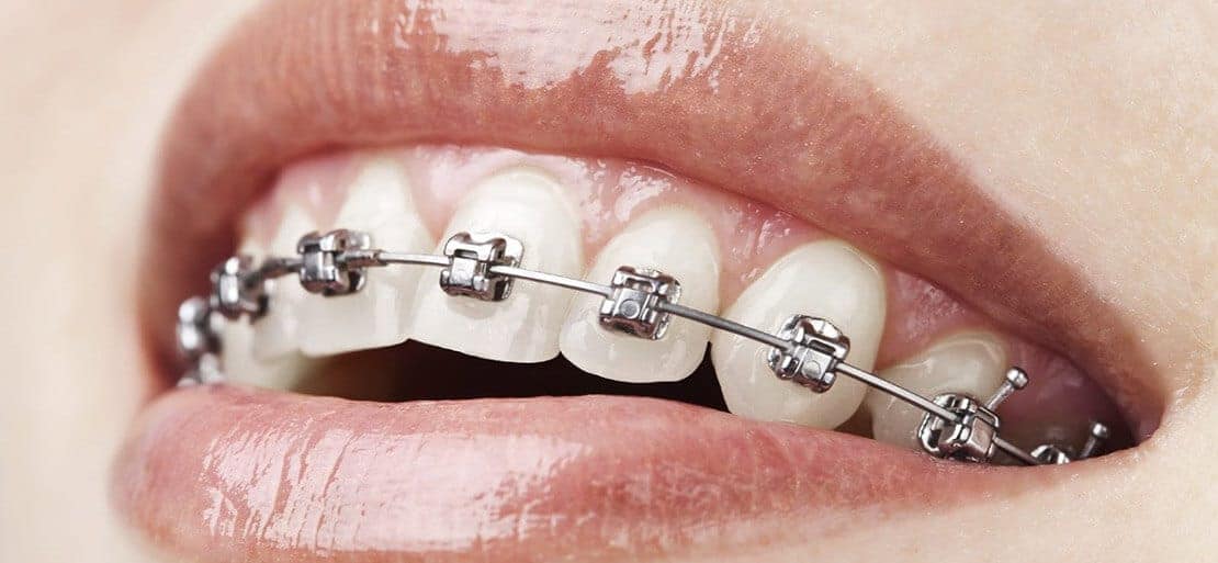 ORTODONCIA AUTOLIGADA